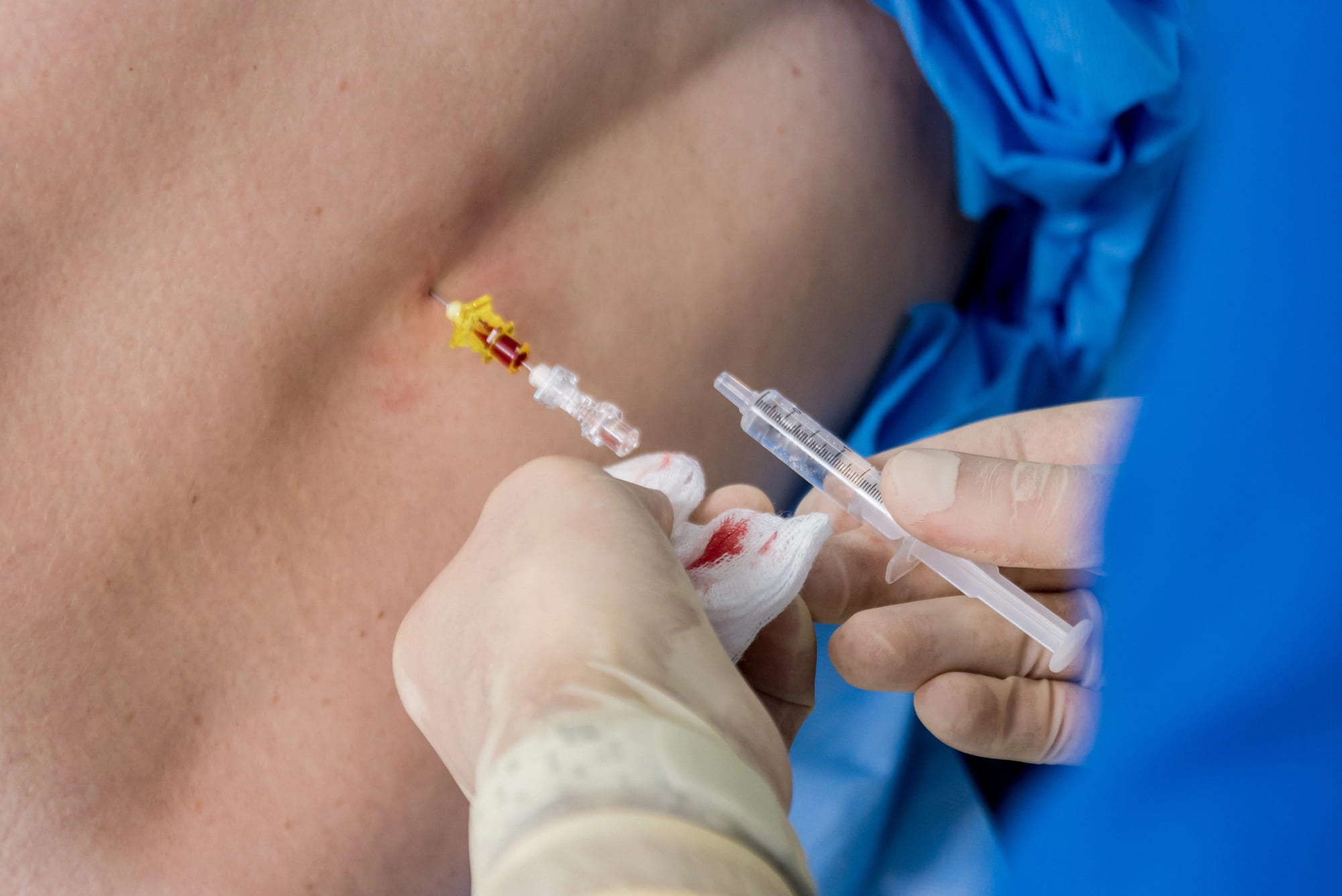 epidural